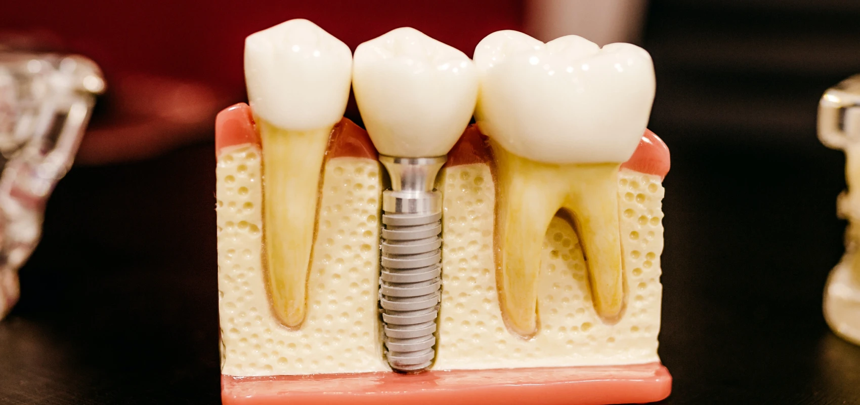 Traitement dent immature marseille