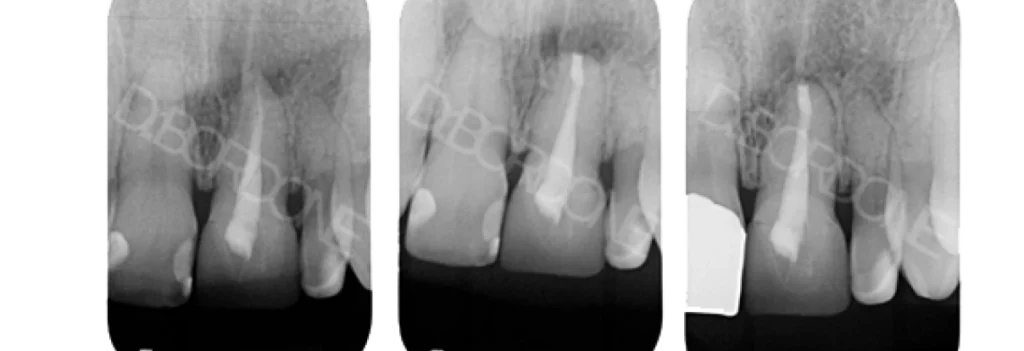 chirurgie endodontique marseille