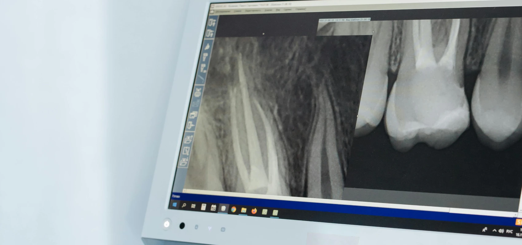 comptes rendus endodontie marseille