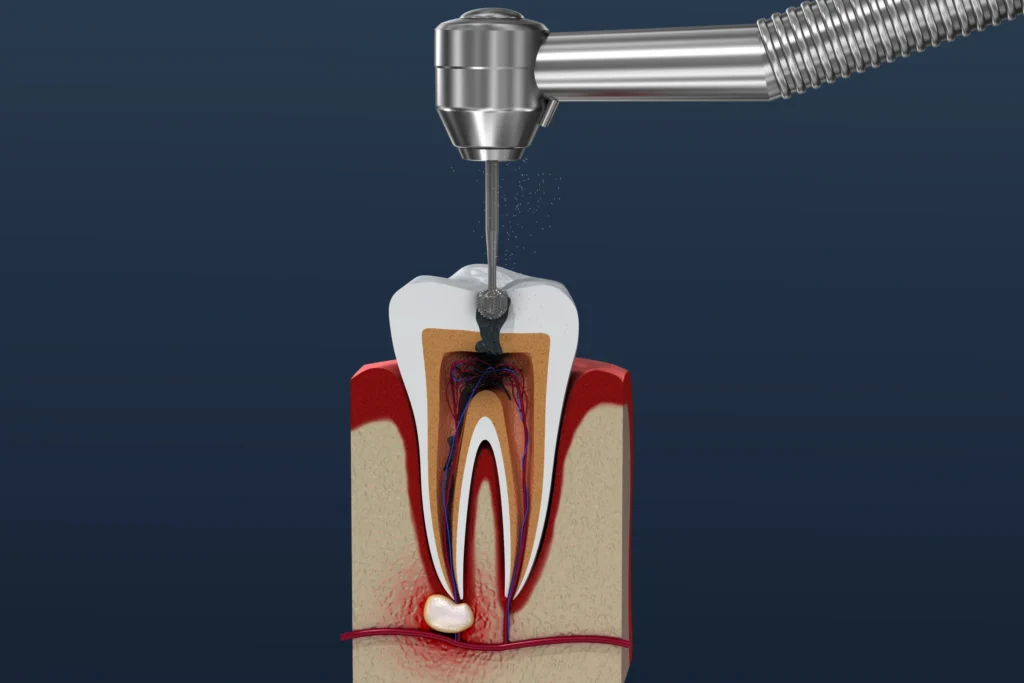 endodontie