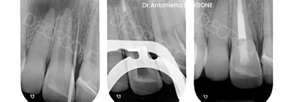 endodontie marseille apexification