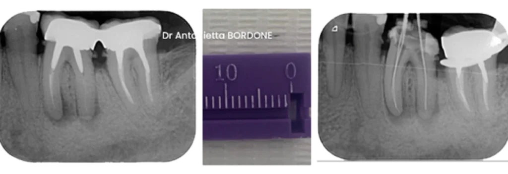 endodontie marseille retrait instrument fracture