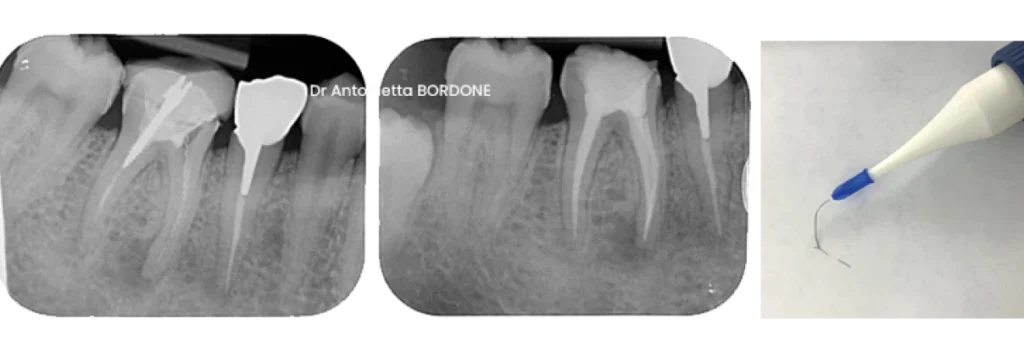 endodontie marseille retrait instrument fracture canal