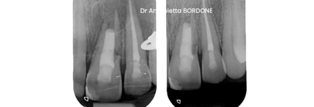 endodontie marseille revascularisation revitalisation