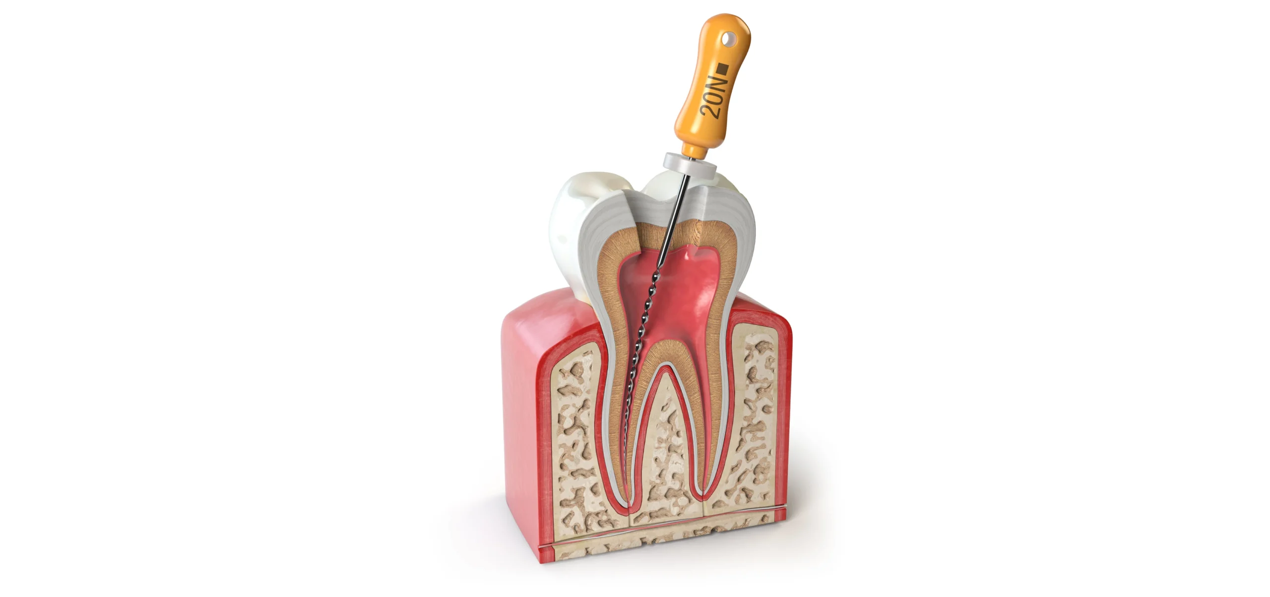 endodontie marseille