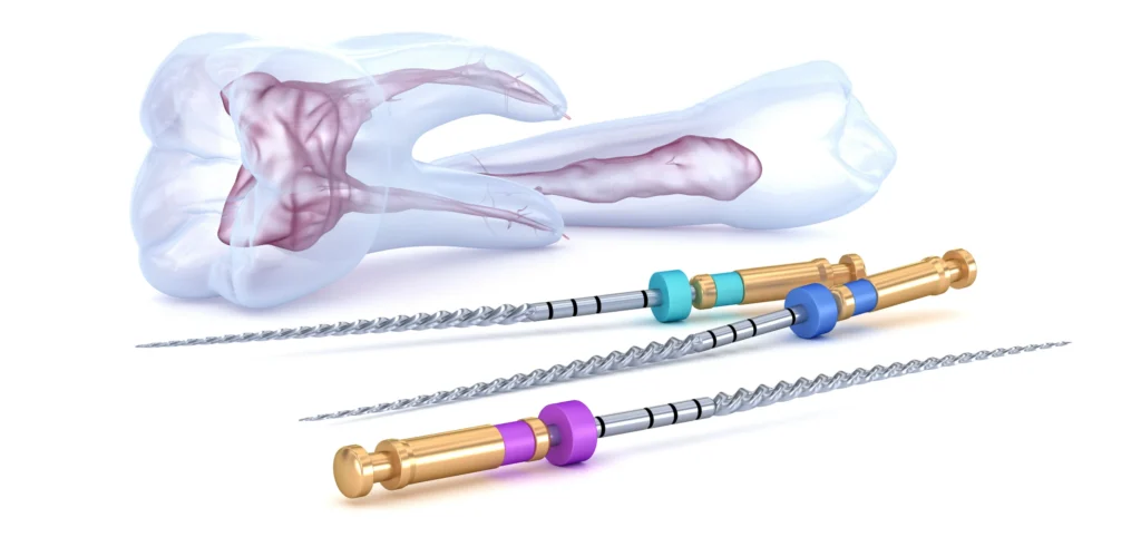 endodontie racine devitalisation marseille