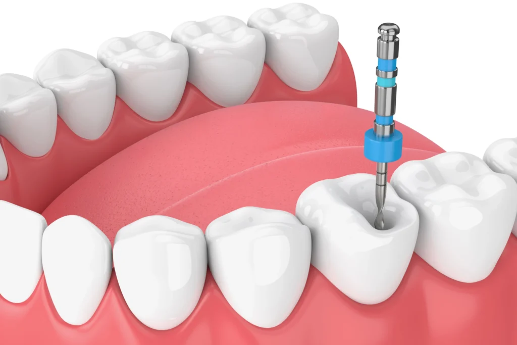 endodontie traitement racines marseille