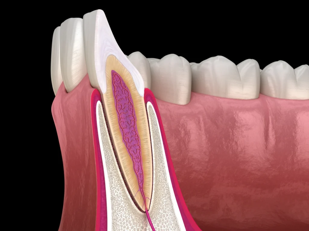 resection apicale endodontie marseille