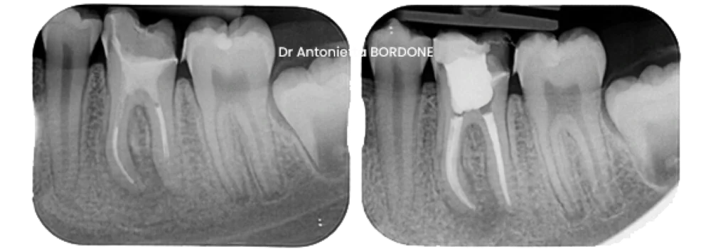 retraitement canalaire endodontie marseille