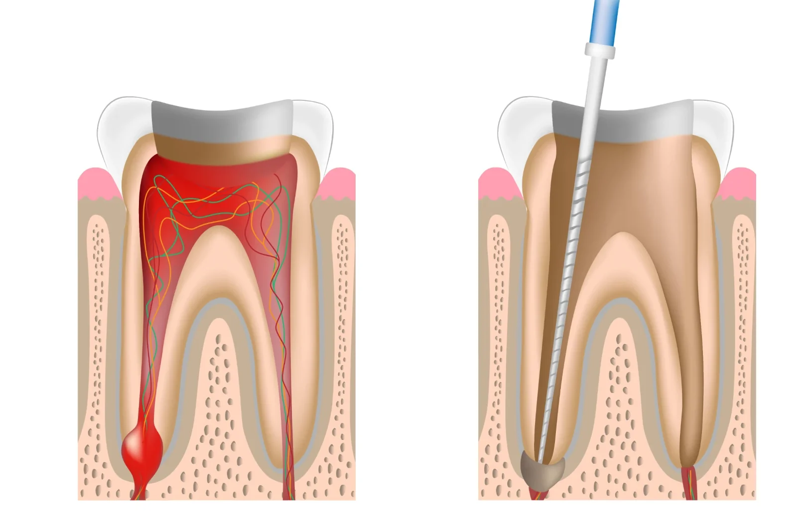endodontie marseille